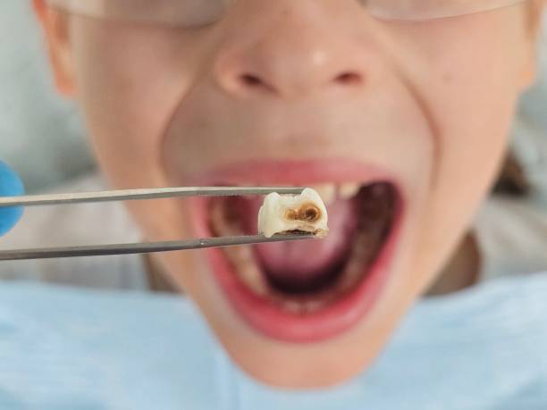 Best Emergency Dental Care for Broken or Chipped Teeth in Beverly Hills, FL